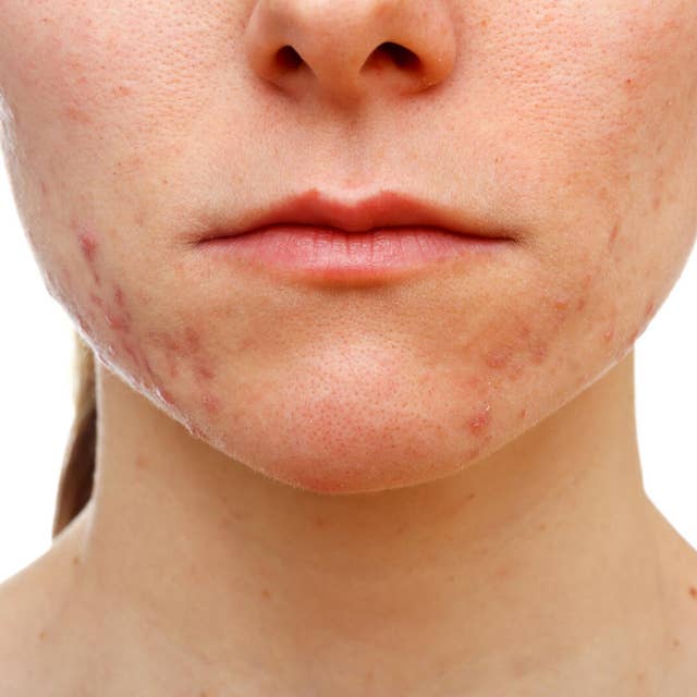Struggling With Acne? Here Are 7 Ways You Can Deal With It