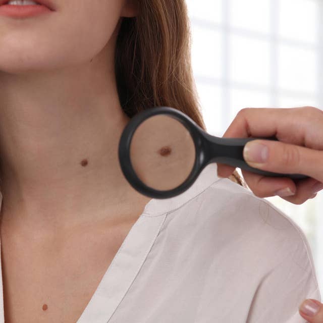 All About Birthmarks: When Should You Worry About Them?