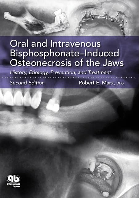 Oral and Intravenous Bisphosphonate: Induced Osteonecrosis of the Jaws: History, Etiology, Prevention, and Treatment (Second Edition): History, Etiology, Prevention, and Treatment, Second Edition