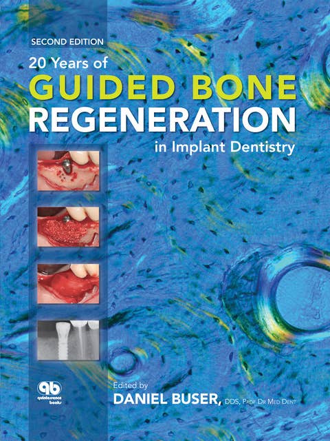 20 Years of Guided Bone Regeneration in Implant Dentistry: Second Edition