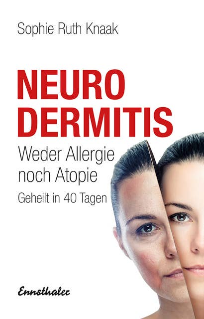 Neurodermitis: Weder Allergie noch Atopie - Geheilt in 40 Tagen