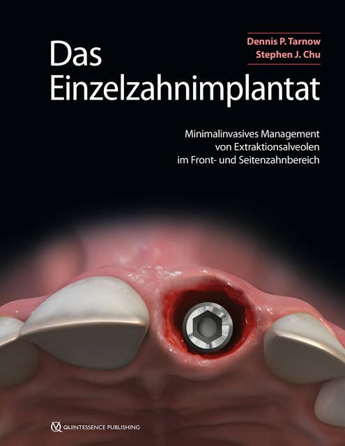 Das Einzelzahnimplantat: Minimalinvasives Management von Extraktionsalveolen im Front- und Seitenzahnbereich